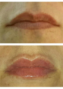 Actual Patient – Before & After – Lip Filler (Belotero Balance)