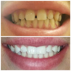 before-after-zoom-whitening-with-bonding
